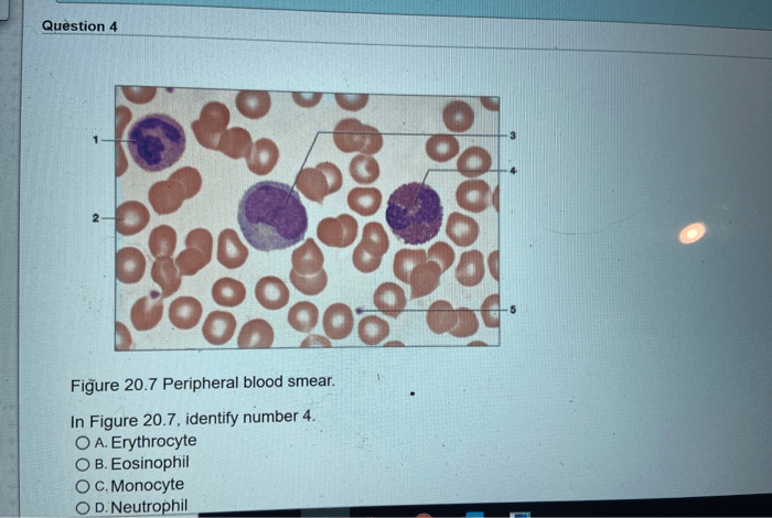 Figure 20.7 peripheral blood smear