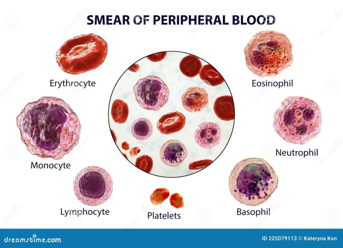 Figure 20.7 peripheral blood smear